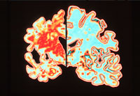 Brain on left with Alzheimer's Disease - new research on causes of Alzheimer's disease