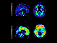 Top images are from the brain of a cognitively normal person. The bottom images are from an Alzheimer’s patient; plaque buildup shows up in red.