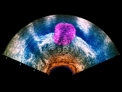 Ultrasound enhanced image of a prostate tumor Ultrasound enhanced image of a prostate tumor