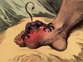 The Gout by James Gillray