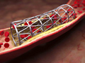 Diagram of a stent inside a cut away view of an  artery.