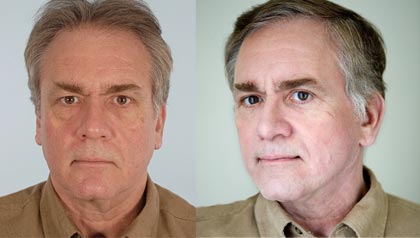 Joe Marek before and after cosmetic surgery