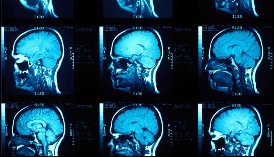 MRI scans of a person's brain