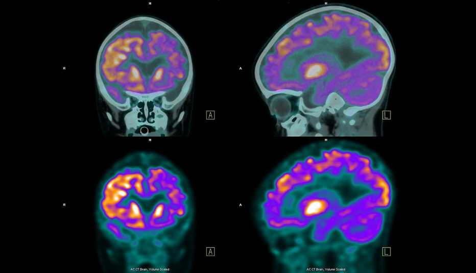 PET (positron emission tomography) scan of the brain