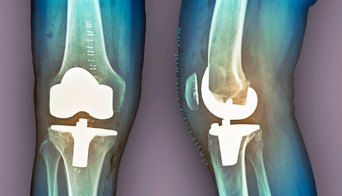 Knee replacement X-Ray