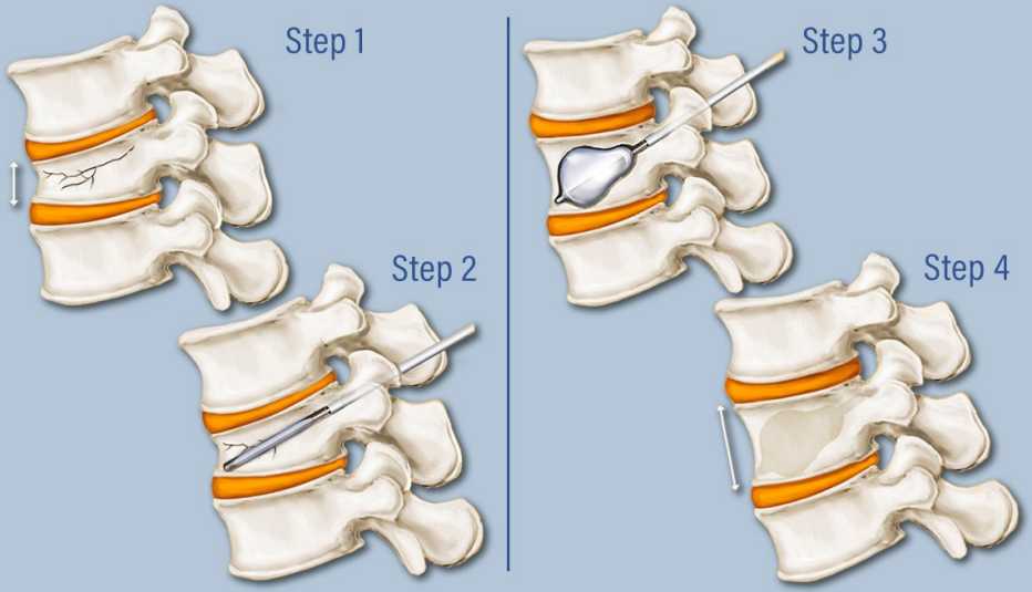 Should You Have Kyphoplasty to Treat a Spinal Fracture?
