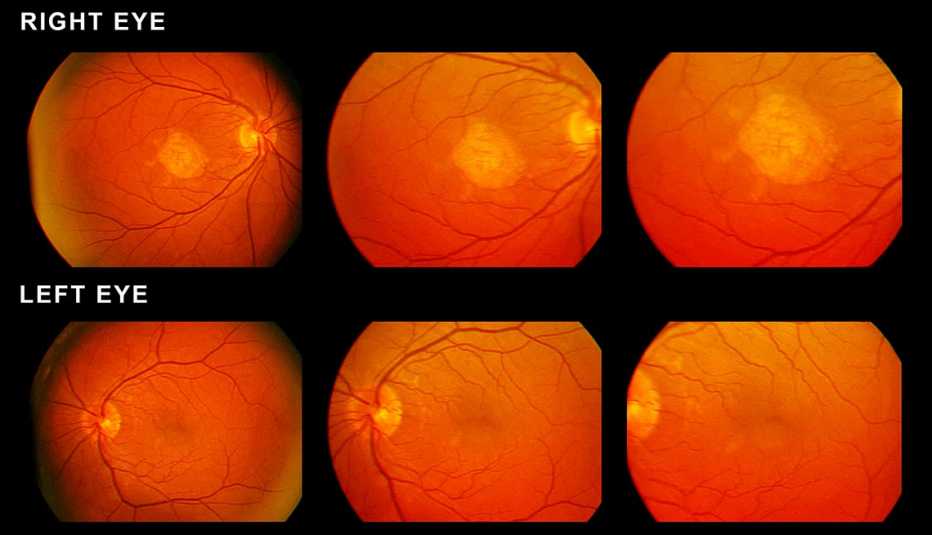 Scan of eyes showing macular degeneration