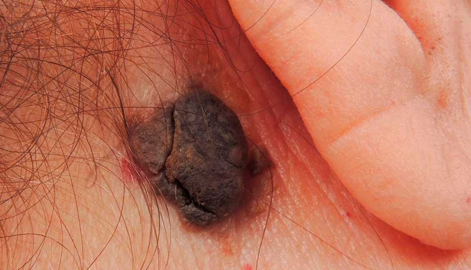 Seborrheic keratosis a dark wart or mole like growth behind the ear. 