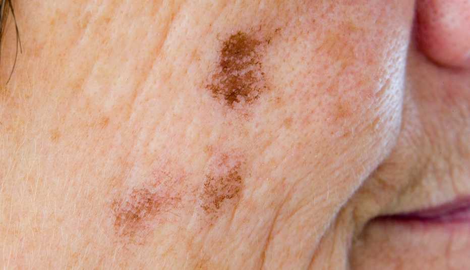 Lentigo Senilis or liver spots on the face of a woman