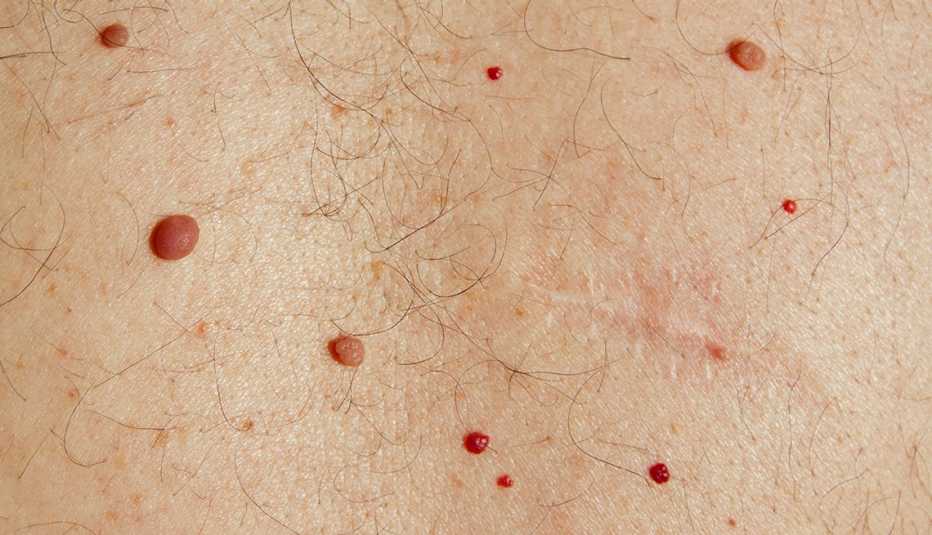 A senior man's back with moles, cysts, cherry angiomas and freckles. Plus a scar from the removal of a cyst .