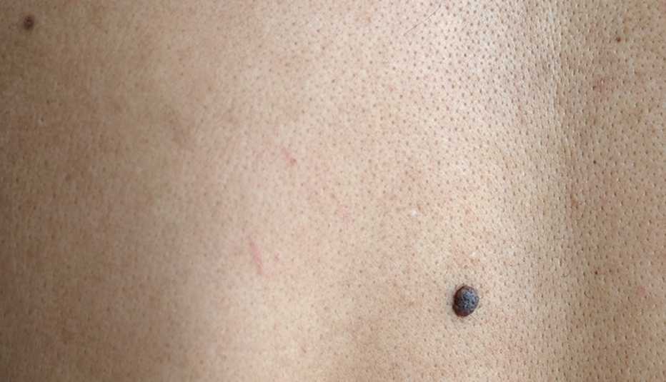 closeup of a mole on a person's back