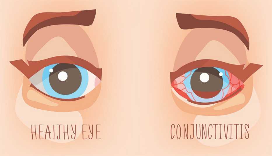 An illustration that shows a healthy eye on the left and an eye suffering from pink eye on the right