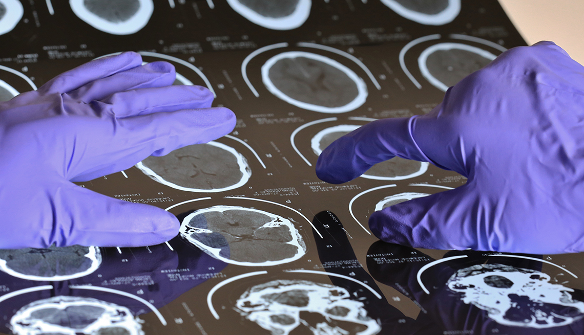 gloved researcher points at brain scans