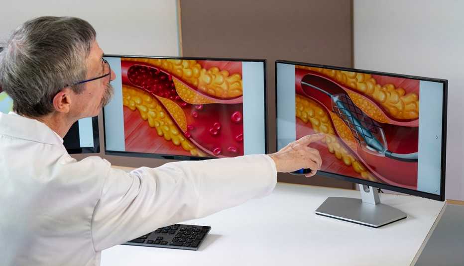 doctor showing atheroma plaque and stent placement images on computer screens
