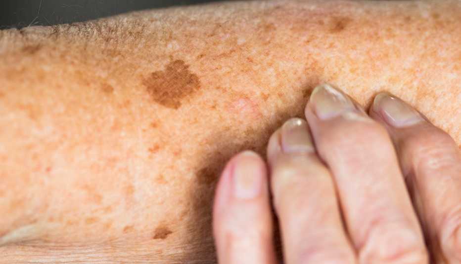 Liver spots, or age spots, on an elderly woman's skin.