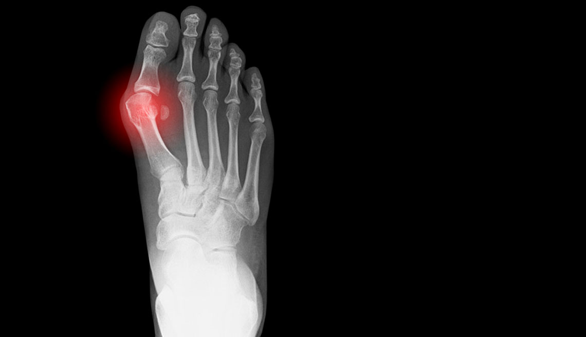 x-ray showing bunion on human foot