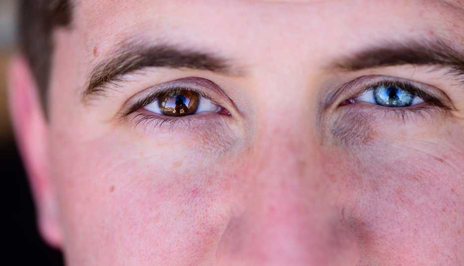 close up of a man with two different colored eyes, known asHeterochromia