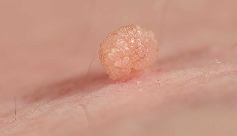 close up of a skin tag or acrochondon