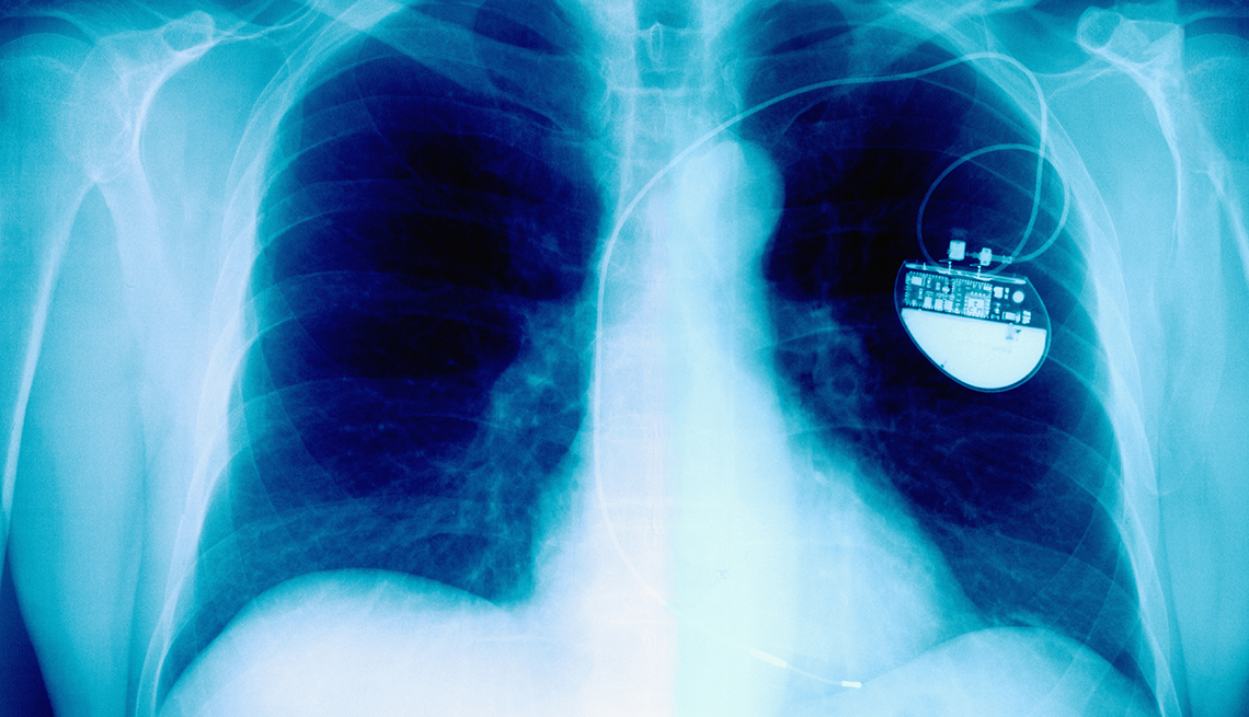 xray of a pacemaker