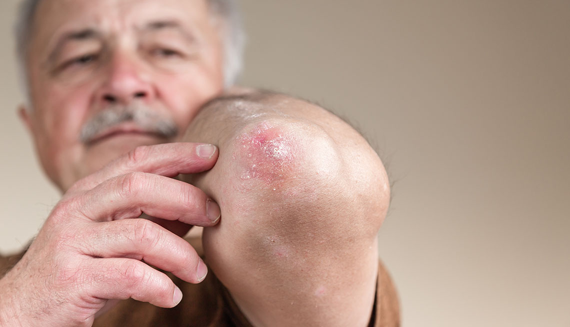 man with psoriasis on the elbow