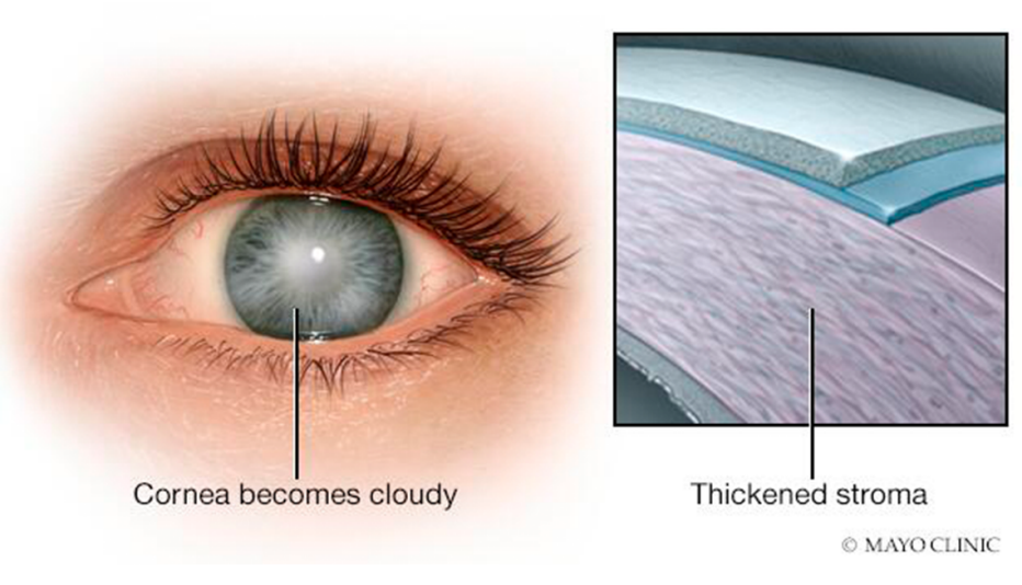 rendering of eye with cloudiness of fuchs dystrophy and a diagram of the thickend stroma of the cornea