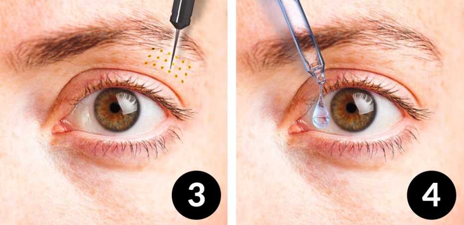 Nonsurgical Eyelid Lift and Prescription eye drops 