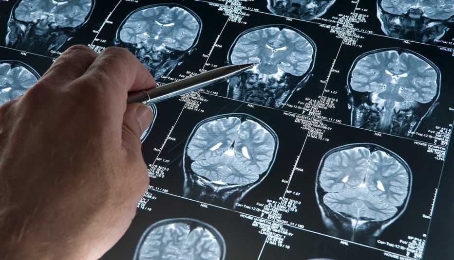 a person points to scans of the brain