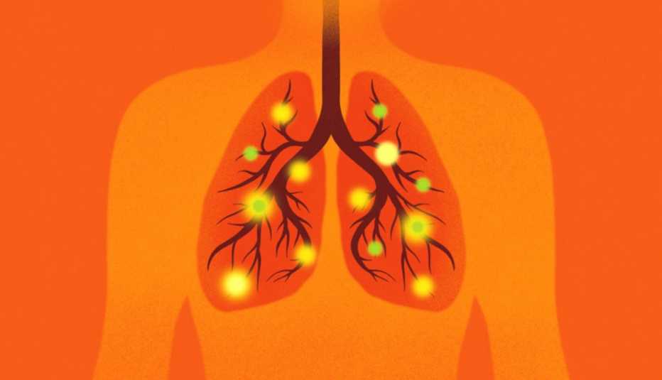 illustration of the human chest with lungs filled with mycoplasma pneumoniae bacterium represented by yellow and green glowing dots on a bright orange background