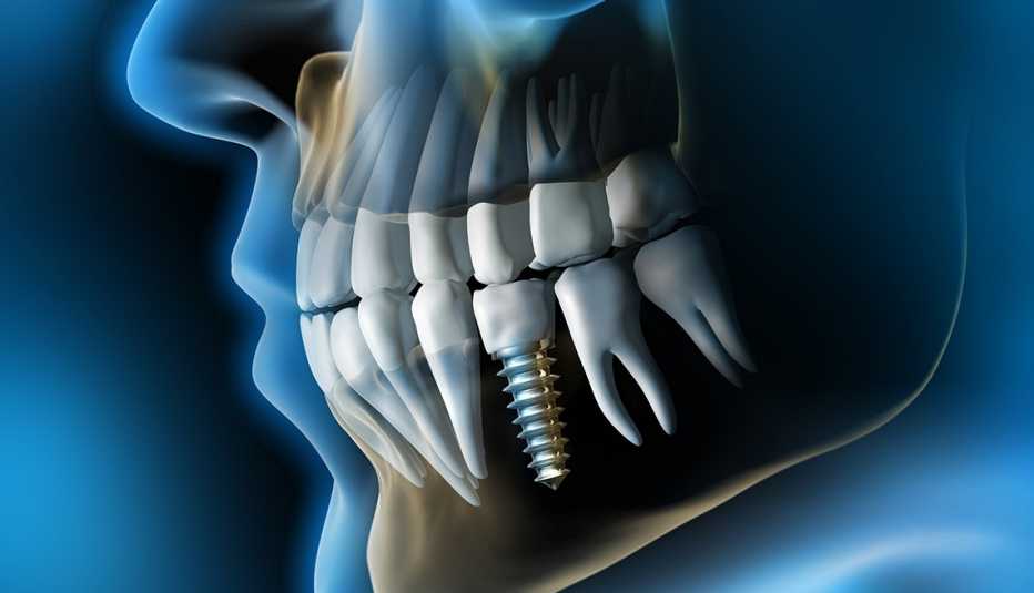 Illustration of a dental implant in the gum