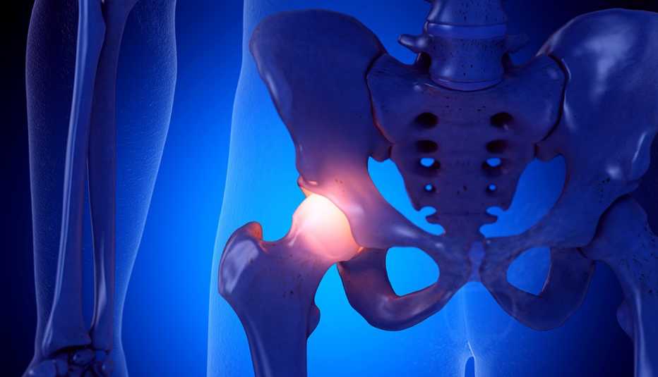 Medical illustration of an inflamed hip joint close up