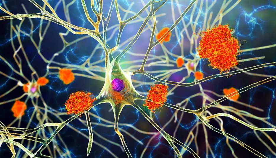 Ilustración de las celulas del sistema nervioso afectadas por la enfermedad de Alzheimer