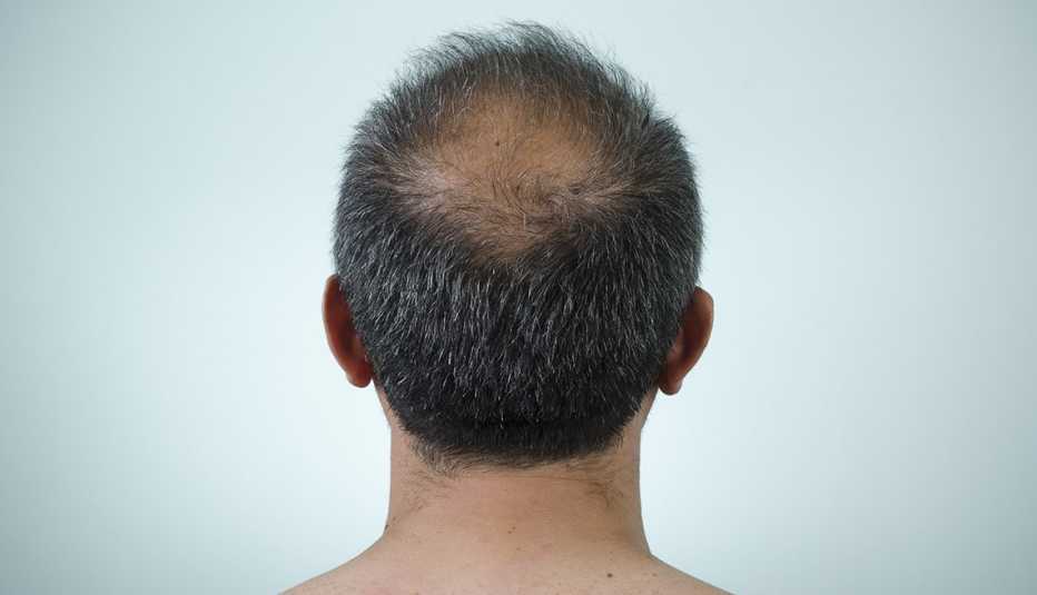 Parte trasera de la cabeza donde se aprecia un área con caída de cabello. 