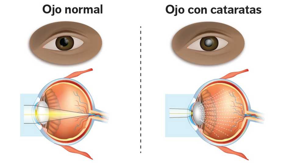Gráfico de ojo normal versus uno con cataratas