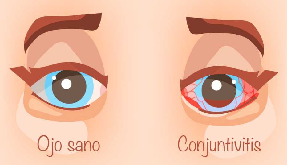 Ilustración de un ojo sano y un ojo con conjuntivitis