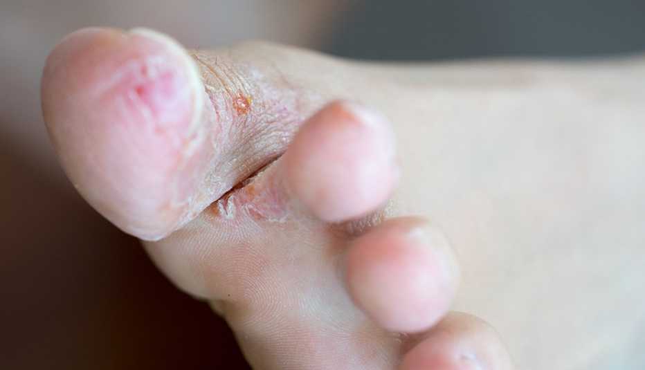 Tinea pedis, o pie de atleta, primer plano de piel agrietada entre los dedos de los pies