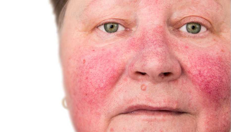 Mujer con enfermedad de la piel rosácea caracterizada por enrojecimiento facial y vasos sanguíneos pequeños y superficiales dilatados.