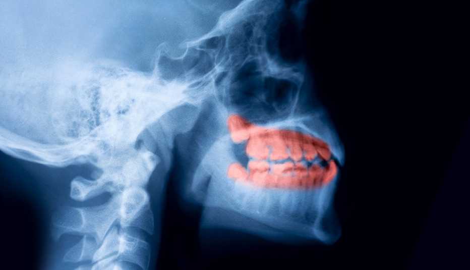 Rayos X que muestra la dentadura de un paciente