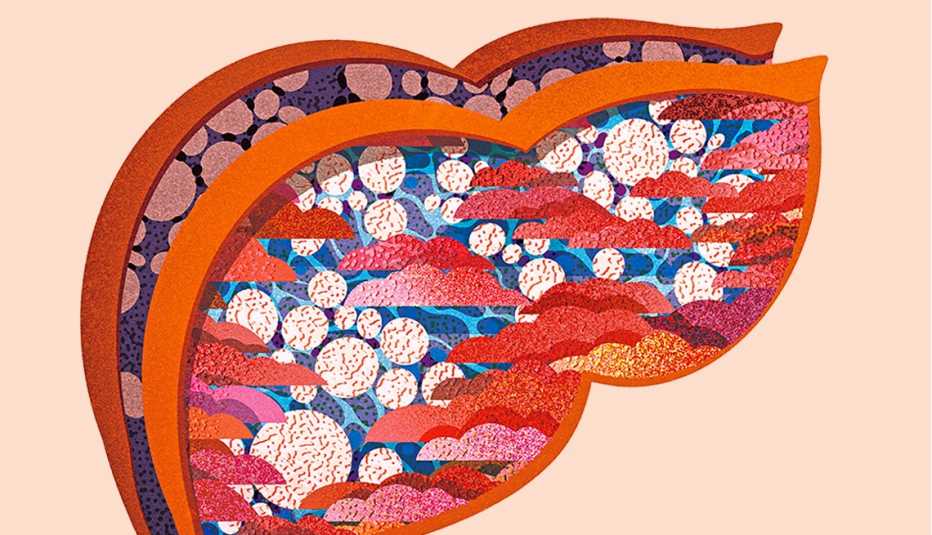 Ilustración de un hígado graso
