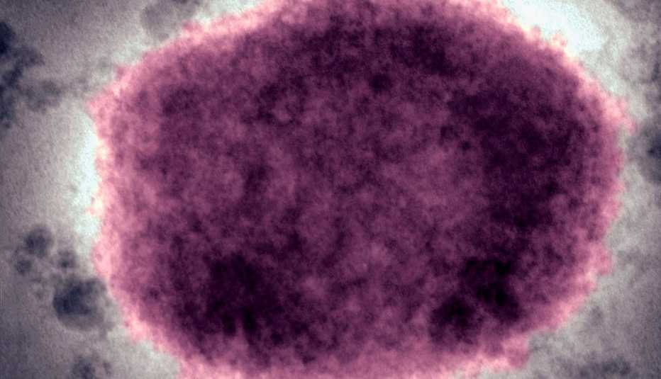 Virus de la viruela del mono presente en líquido vesicular humano..