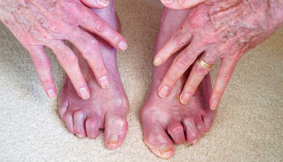 Dedos de manos y pies con artritis