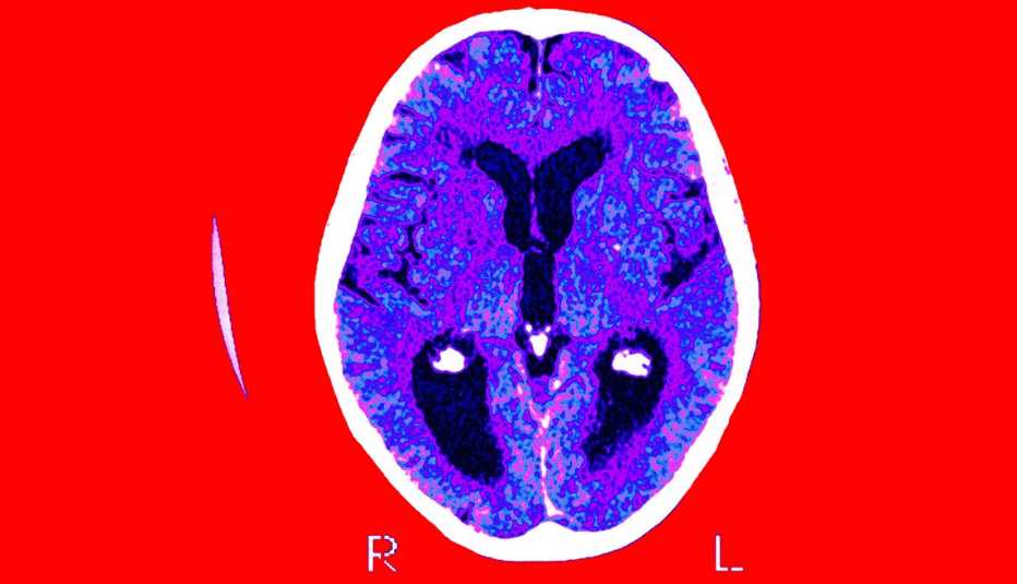 Exploración de un cerebro con la enfermedad de Alzheimer