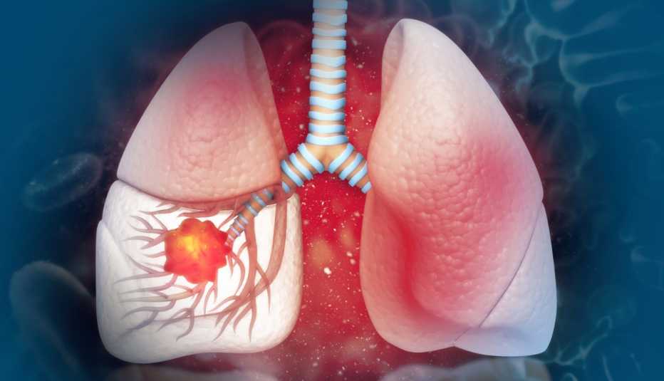 Ilustración de cáncer de pulmón en el pulmón izquierdo sobre un fondo azul con células sanguíneas
