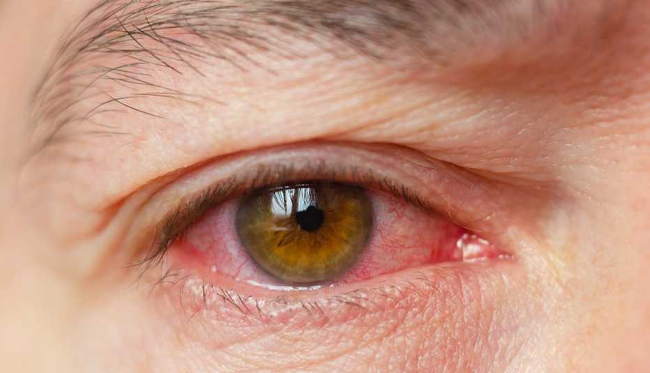 Toma cercana de un ojo infectado con conjuntivitis