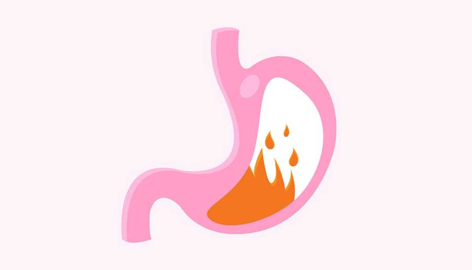 Ilustración de un estómago en llamas que representa la acidez y el reflujo