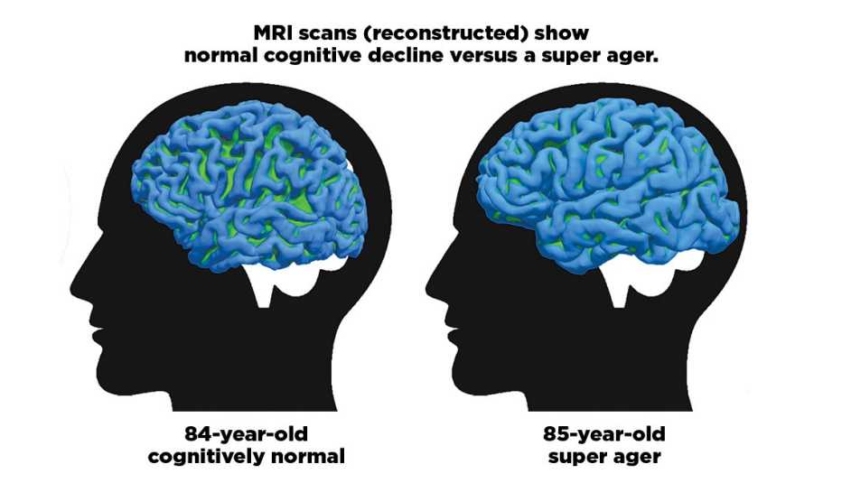 Imágenes por resonancia magnética que comparan el deterioro cognitivo normal de una persona mayor con el de un superanciano.