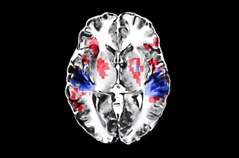 Un escáner cerebral que muestra áreas estimuladas por música nueva escuchada recientemente (azul) y por melodías conocidas desde hace mucho tiempo (rojo)