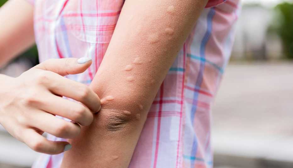 Una mujer se rasca unas picadas de mosquito en su brazo.