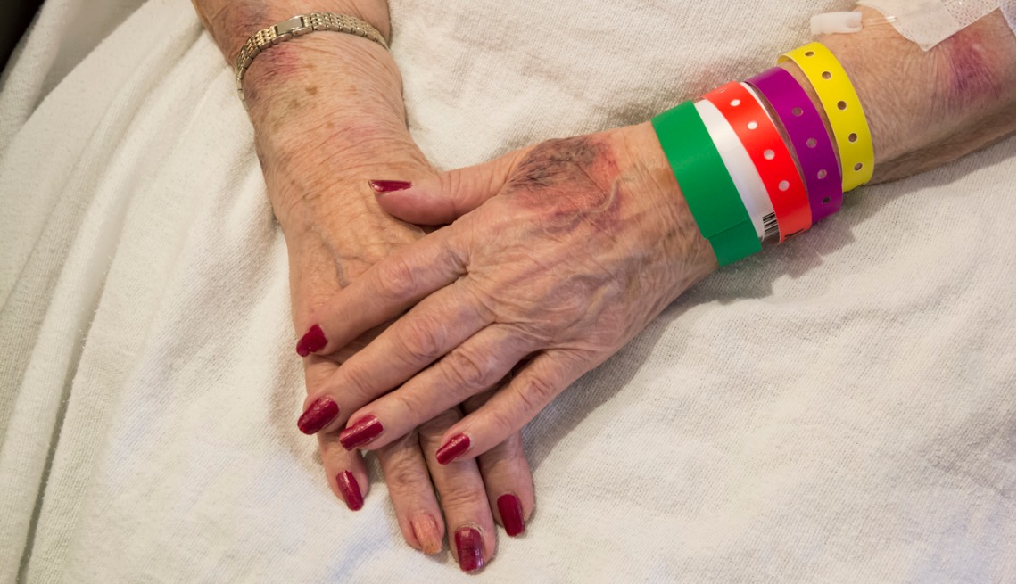 Bruised Hands of Elderly Woman in Emergency Room
