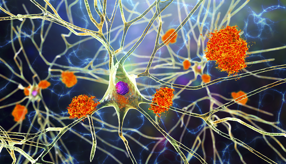 Ilustración de las celulas del sistema nervioso afectadas por la enfermedad de Alzheimer