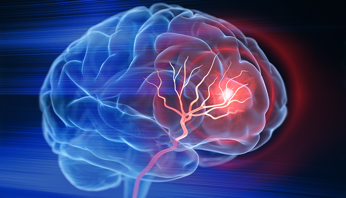 Ilustración de un cerebro humano que sufre un derrame cerebral